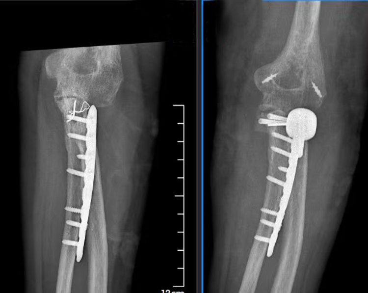 意外摔成肘关节&ldquo;恐怖三联征&rdquo;重庆长城骨科医院专家团队妙手解病痛