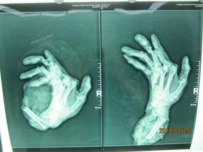 广州阿伯右手卷入机器“骨肉分离”,医生11小时帮他接回手臂